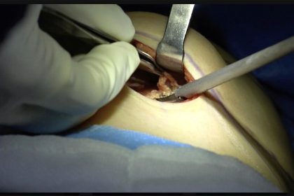 Silent Infection Found During a Third Breast Augmentation: What the Pocket Revealed