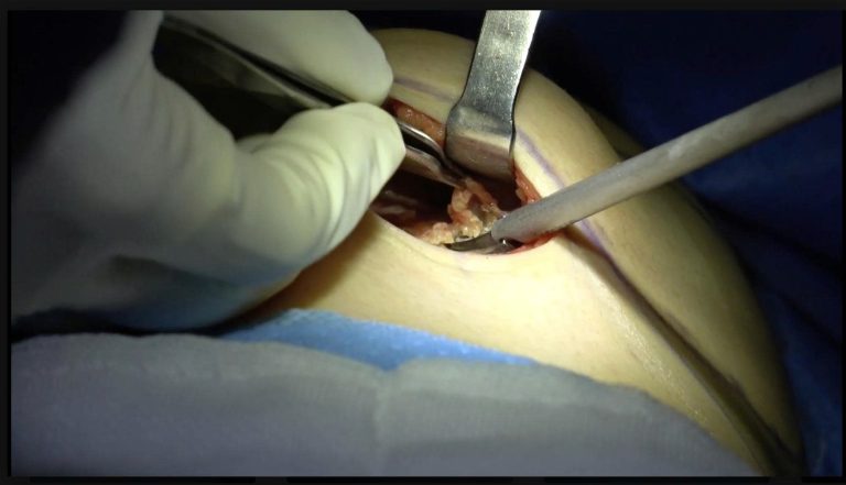 Silent Infection Found During a Third Breast Augmentation: What the Pocket Revealed