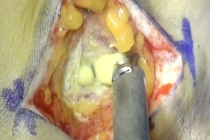 Comparing Complications: Subglandular Placement Leading to Implant Visibility vs. Dual-Plane Resulting in Bottoming-Out and Implant Malposition