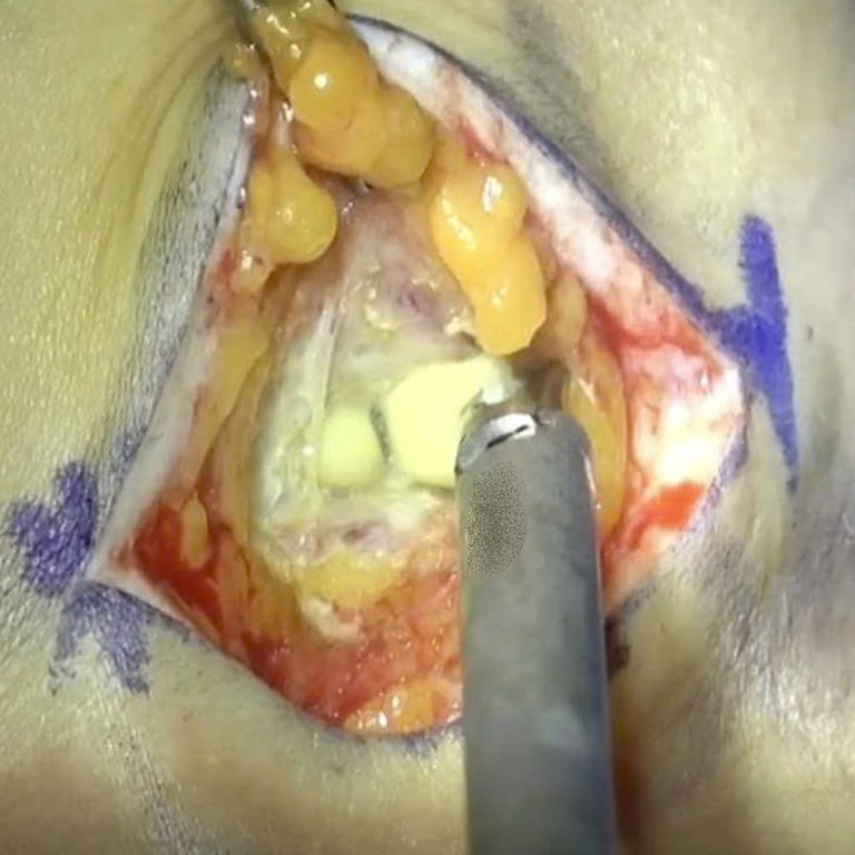 Comparing Complications: Subglandular Placement Leading to Implant Visibility vs. Dual-Plane Resulting in Bottoming-Out and Implant Malposition
