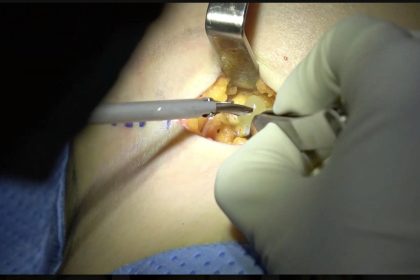 Breast Implant Removal in Vietnam: Cost & Safety Guide