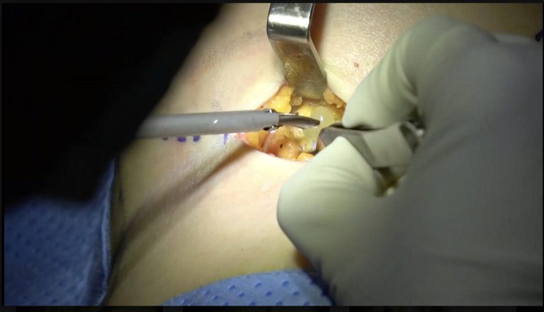 Breast Implant Removal in Vietnam: Cost & Safety Guide
