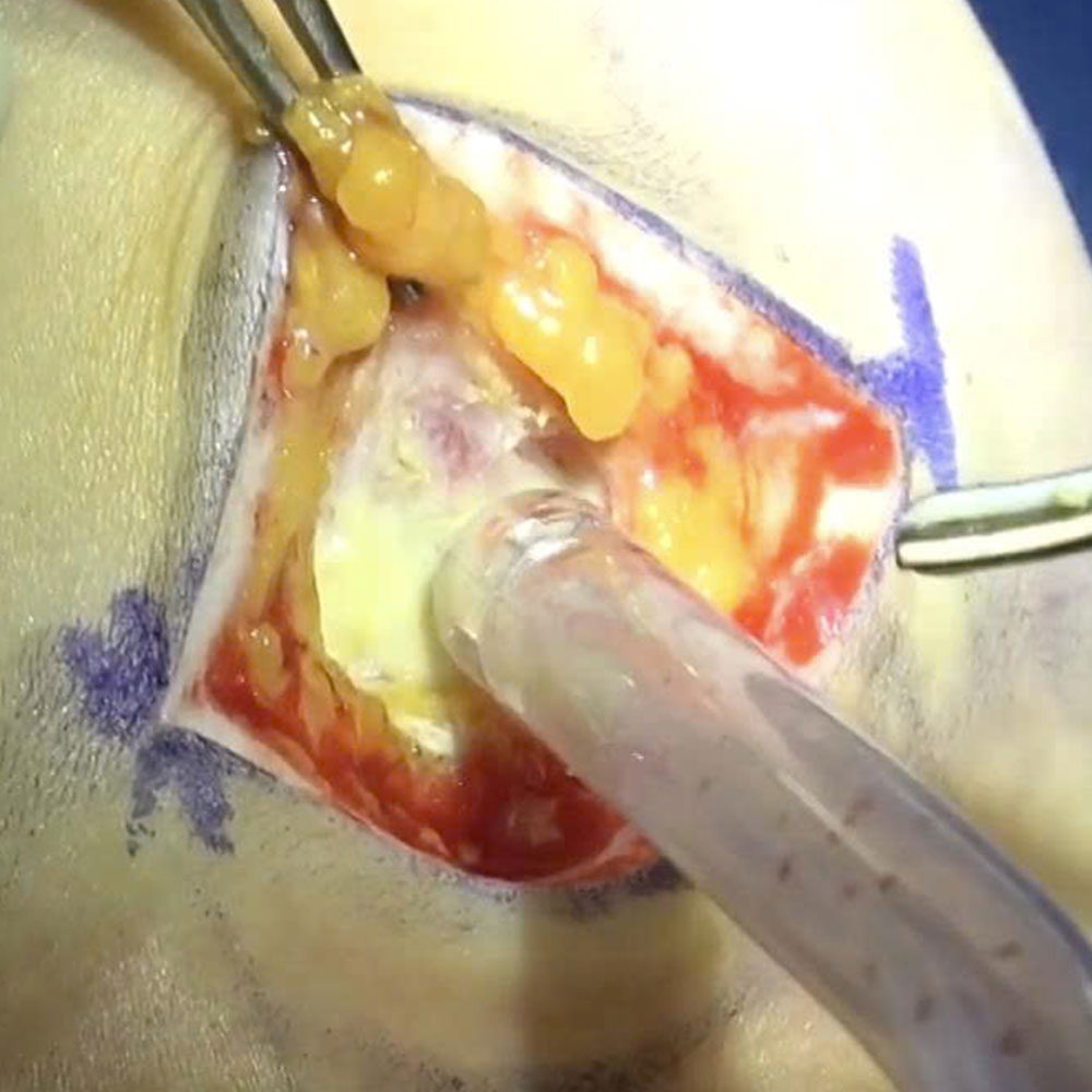Comparing Complications: Subglandular Placement Leading to Implant Visibility vs. Dual-Plane Resulting in Bottoming-Out and Implant Malposition