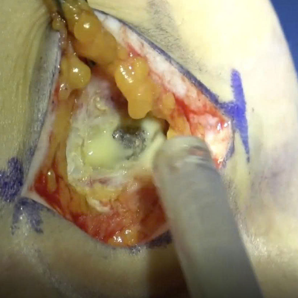 Comparing Complications: Subglandular Placement Leading to Implant Visibility vs. Dual-Plane Resulting in Bottoming-Out and Implant Malposition