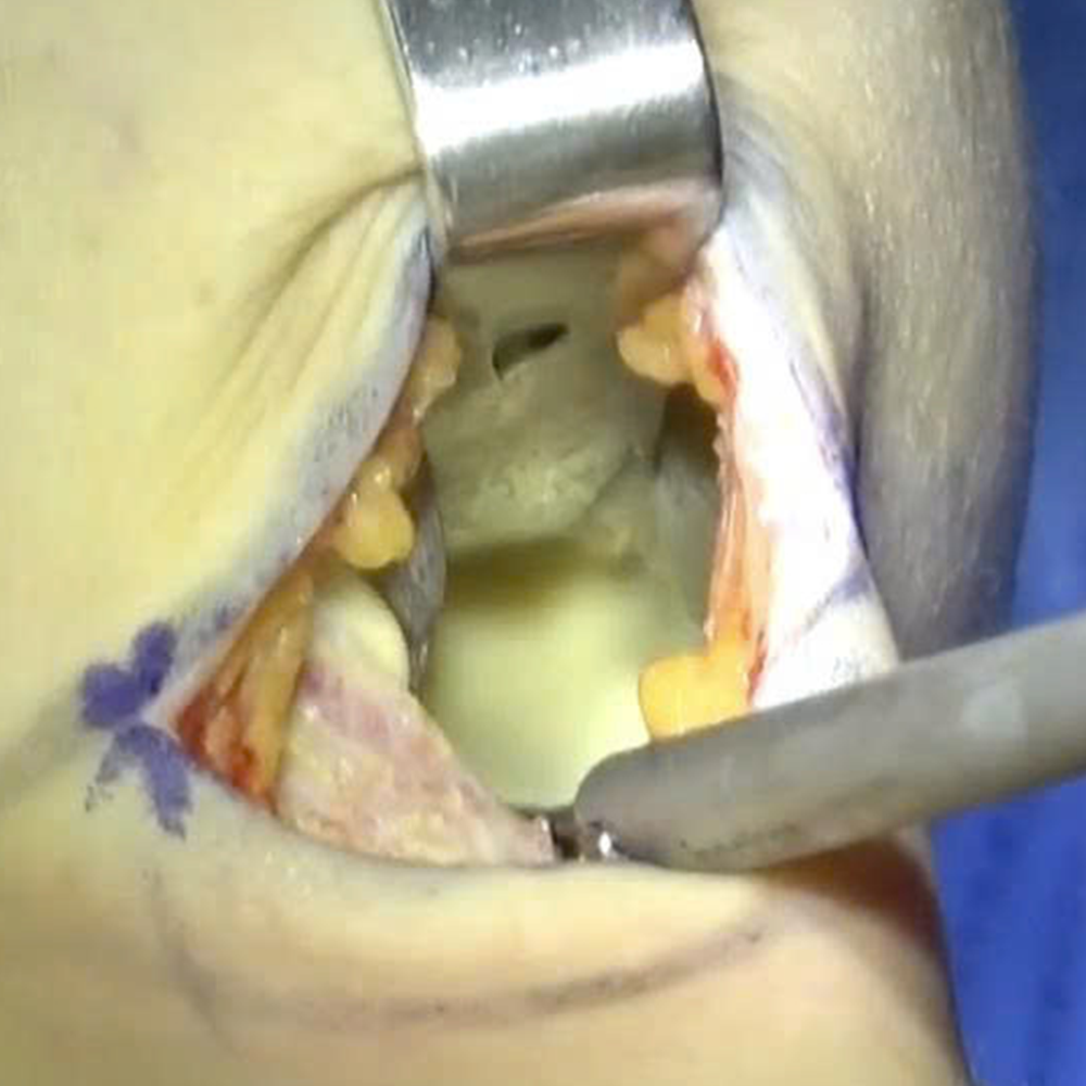Comparing Complications: Subglandular Placement Leading to Implant Visibility vs. Dual-Plane Resulting in Bottoming-Out and Implant Malposition