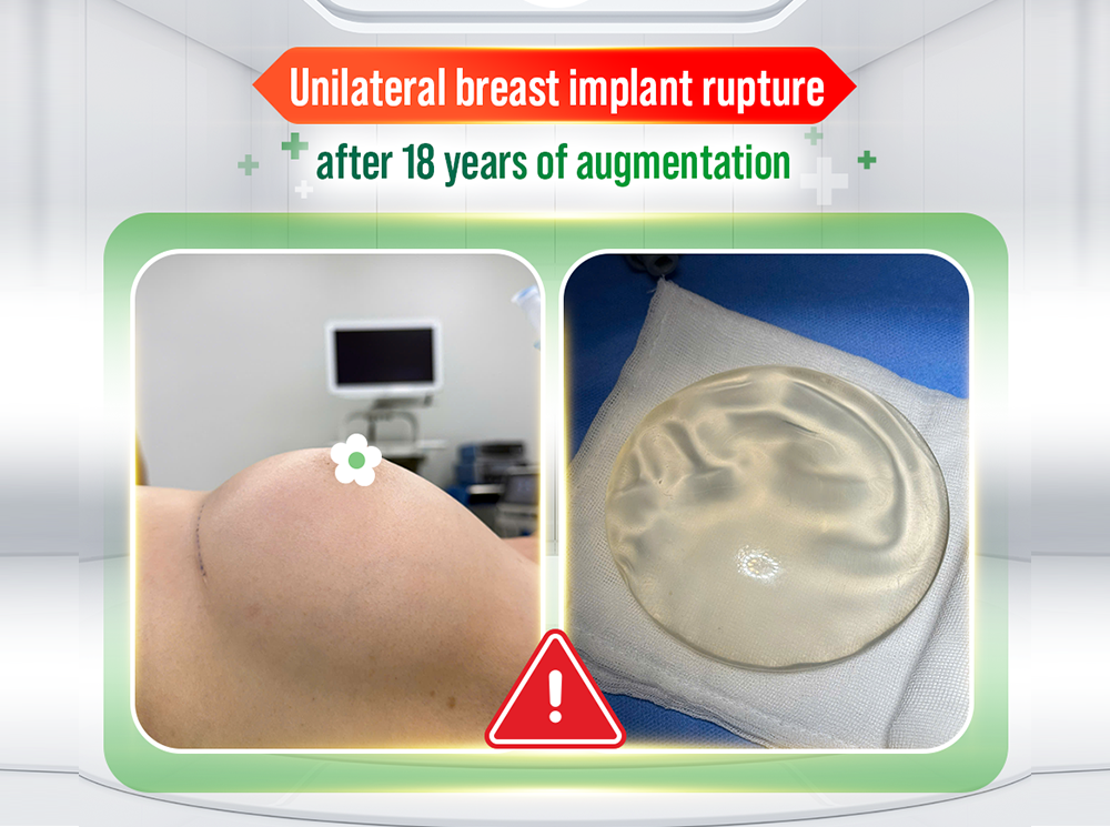 UNILATERAL BREAST IMPLANT RUPTURE AFTER 18 YEARS: AN AUSTRALIAN-VIETNAMESE PATIENT WITH A HISTORY OF BREAST CANCER TREATMENT OPTS FOR EXPLANTATION IN VIETNAM
