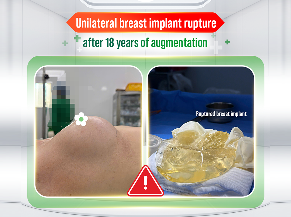 UNILATERAL BREAST IMPLANT RUPTURE AFTER 18 YEARS: AN AUSTRALIAN-VIETNAMESE PATIENT WITH A HISTORY OF BREAST CANCER TREATMENT OPTS FOR EXPLANTATION IN VIETNAM