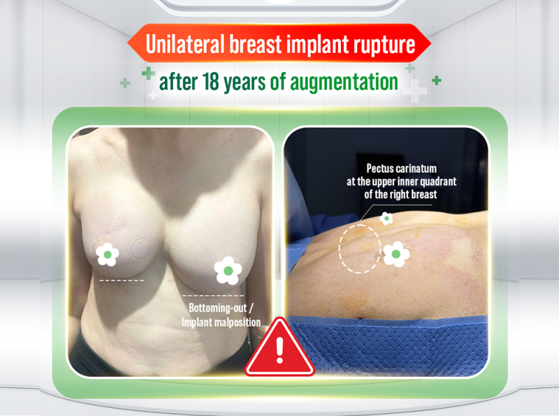 UNILATERAL BREAST IMPLANT RUPTURE AFTER 18 YEARS: AN AUSTRALIAN-VIETNAMESE PATIENT WITH A HISTORY OF BREAST CANCER TREATMENT OPTS FOR EXPLANTATION IN VIETNAM