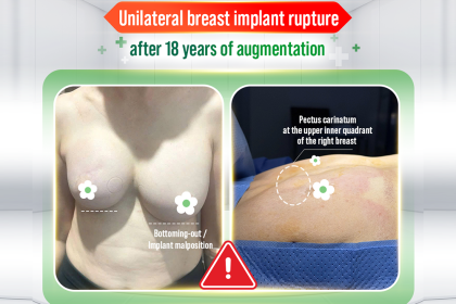 Unilateral Breast Implant Rupture After 18 Years: An Australian-Vietnamese Patient With A History Of Breast Cancer Treatment Opts For Explantation In Vietnam