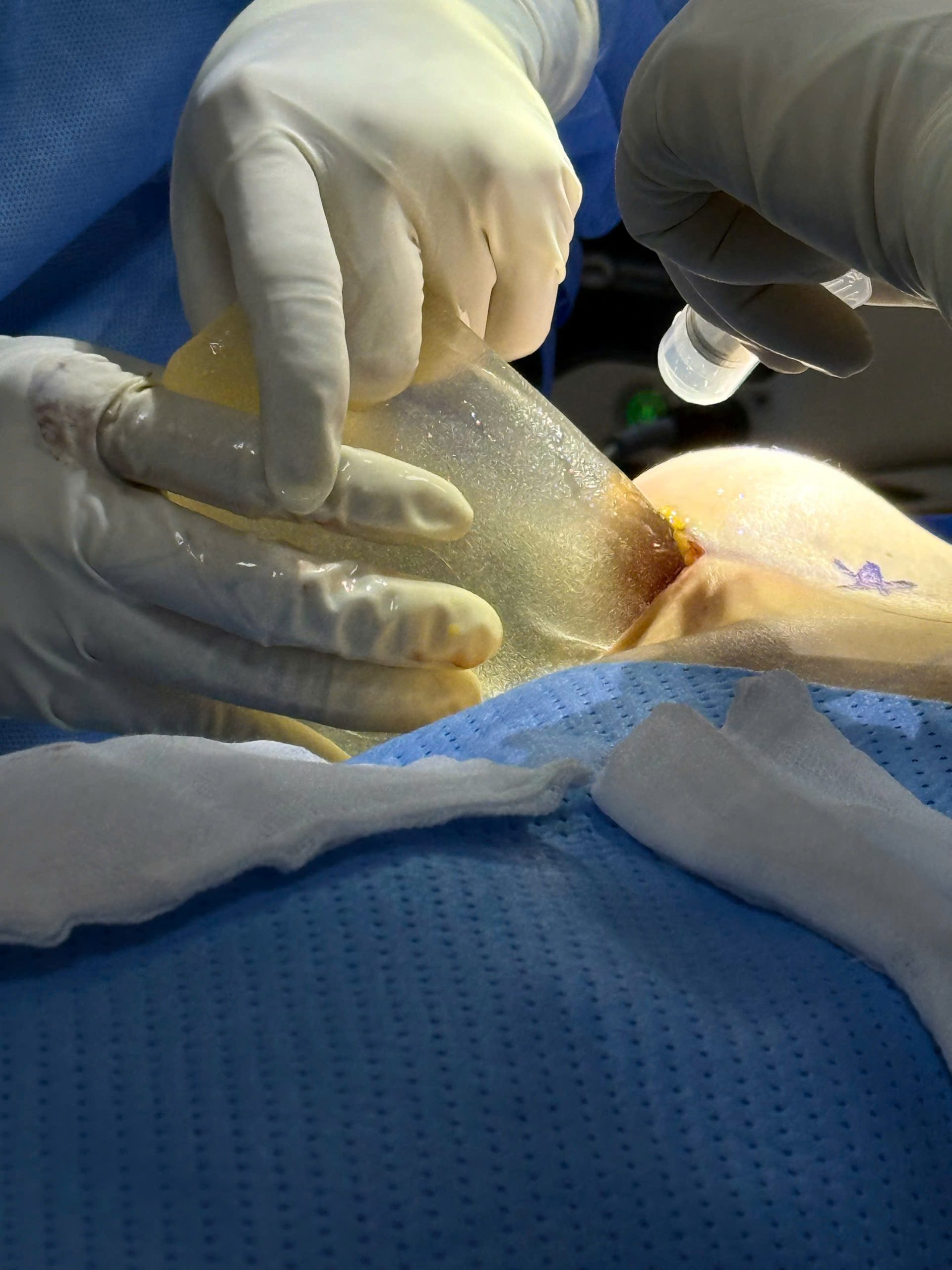 Breast Implant Removal in Vietnam: Cost & Safety Guide