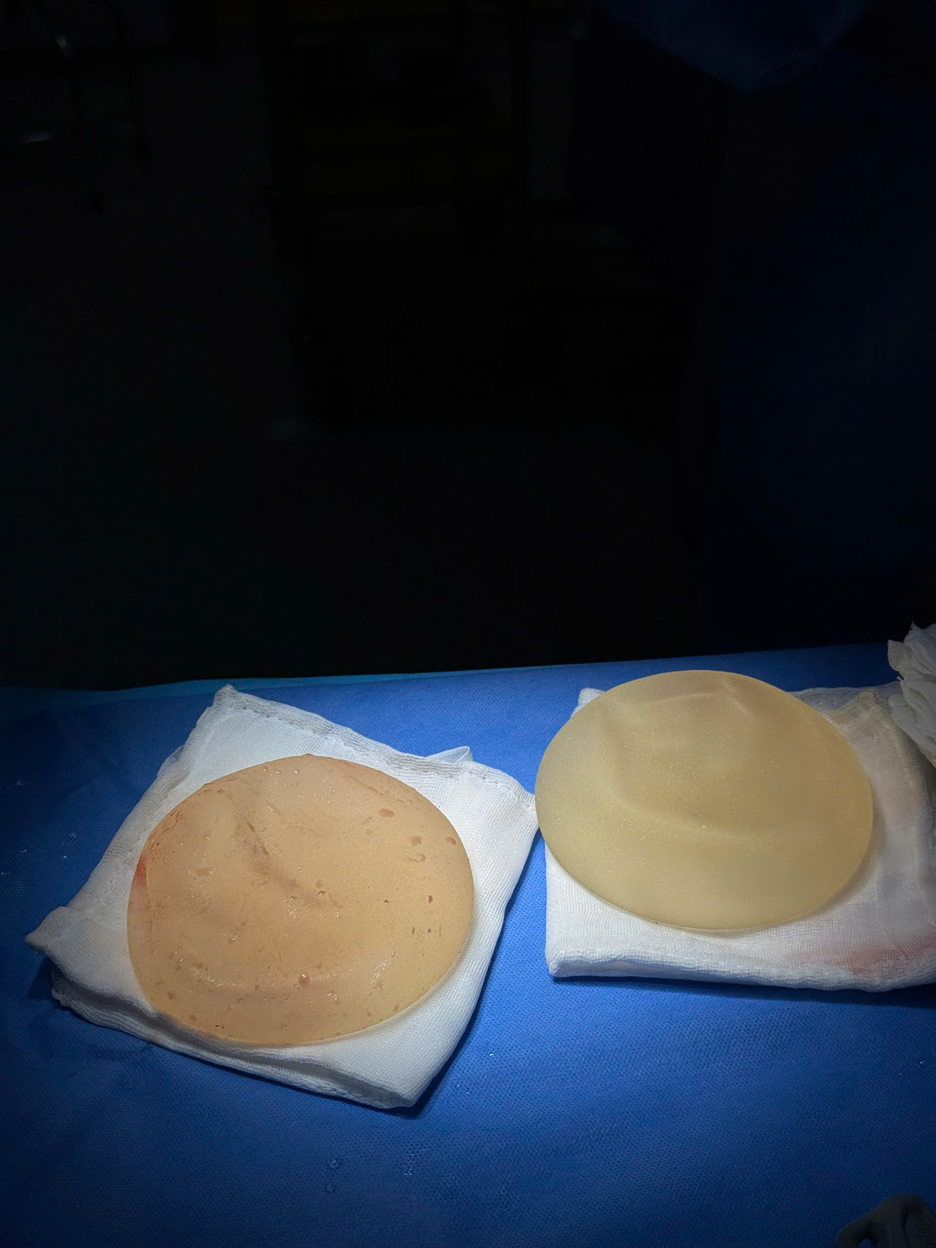 Breast Implant Removal in Vietnam: Cost & Safety Guide