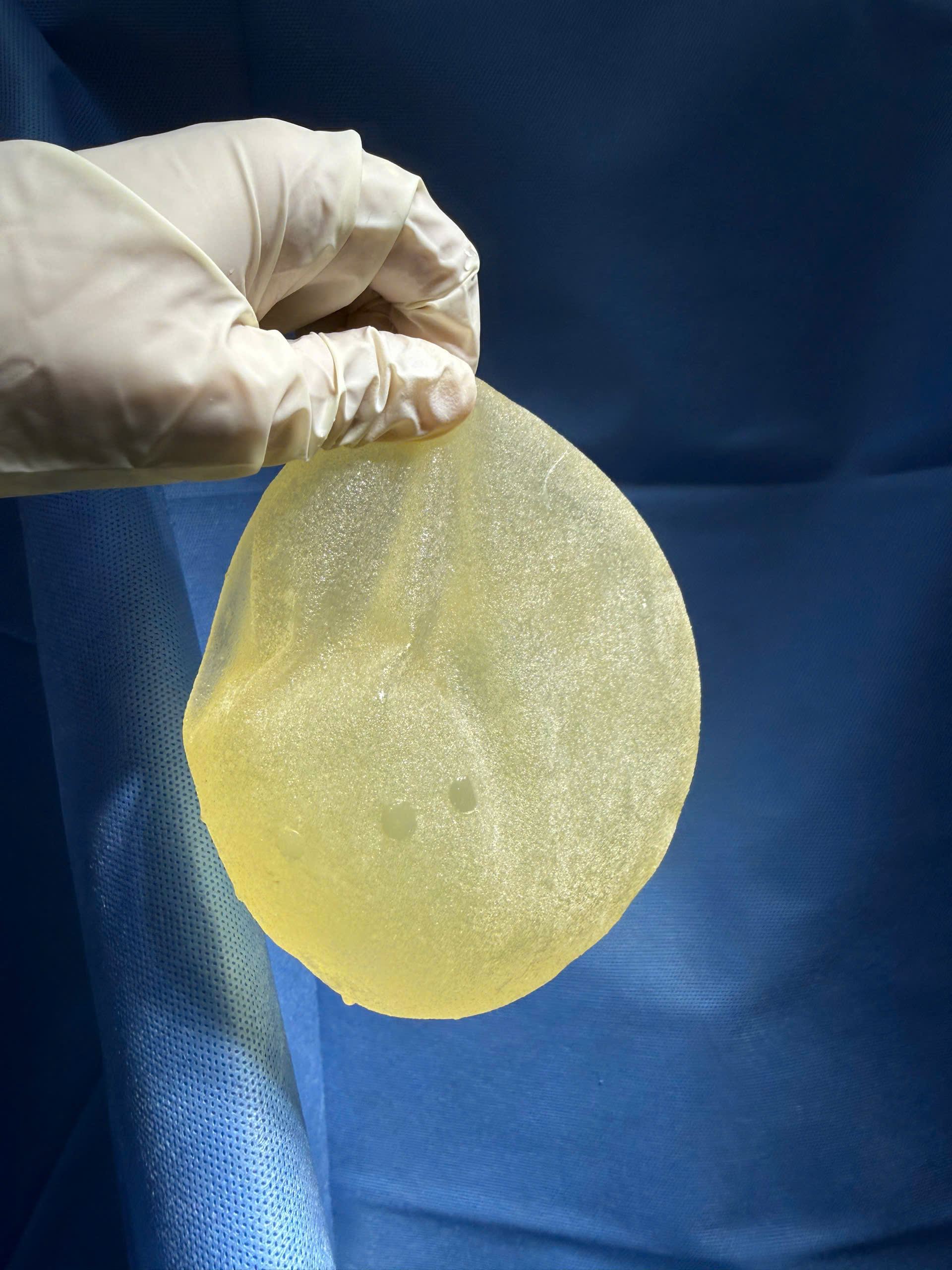 Breast Implant Removal in Vietnam: Cost & Safety Guide