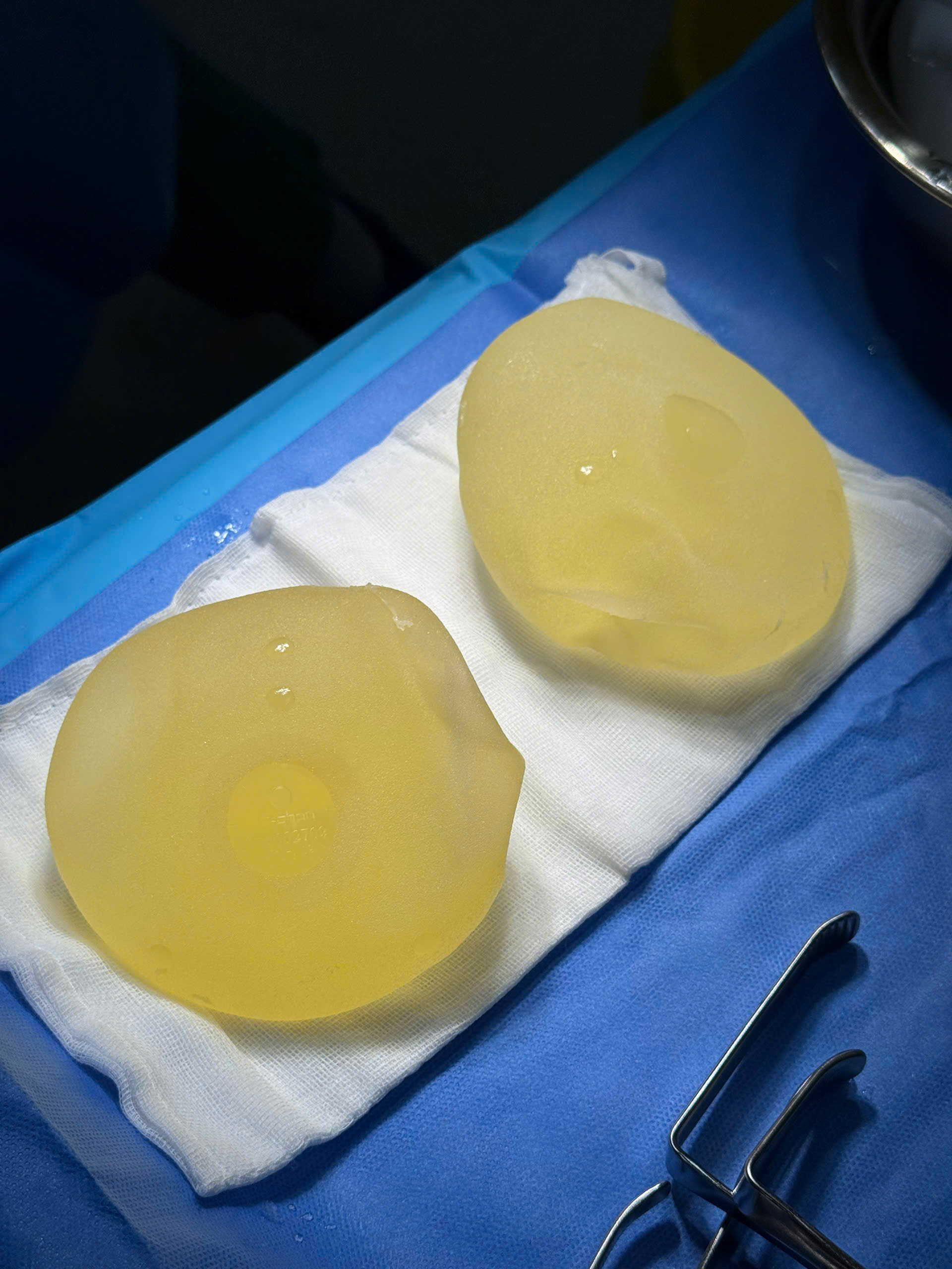 Breast Implant Removal in Vietnam: Cost & Safety Guide