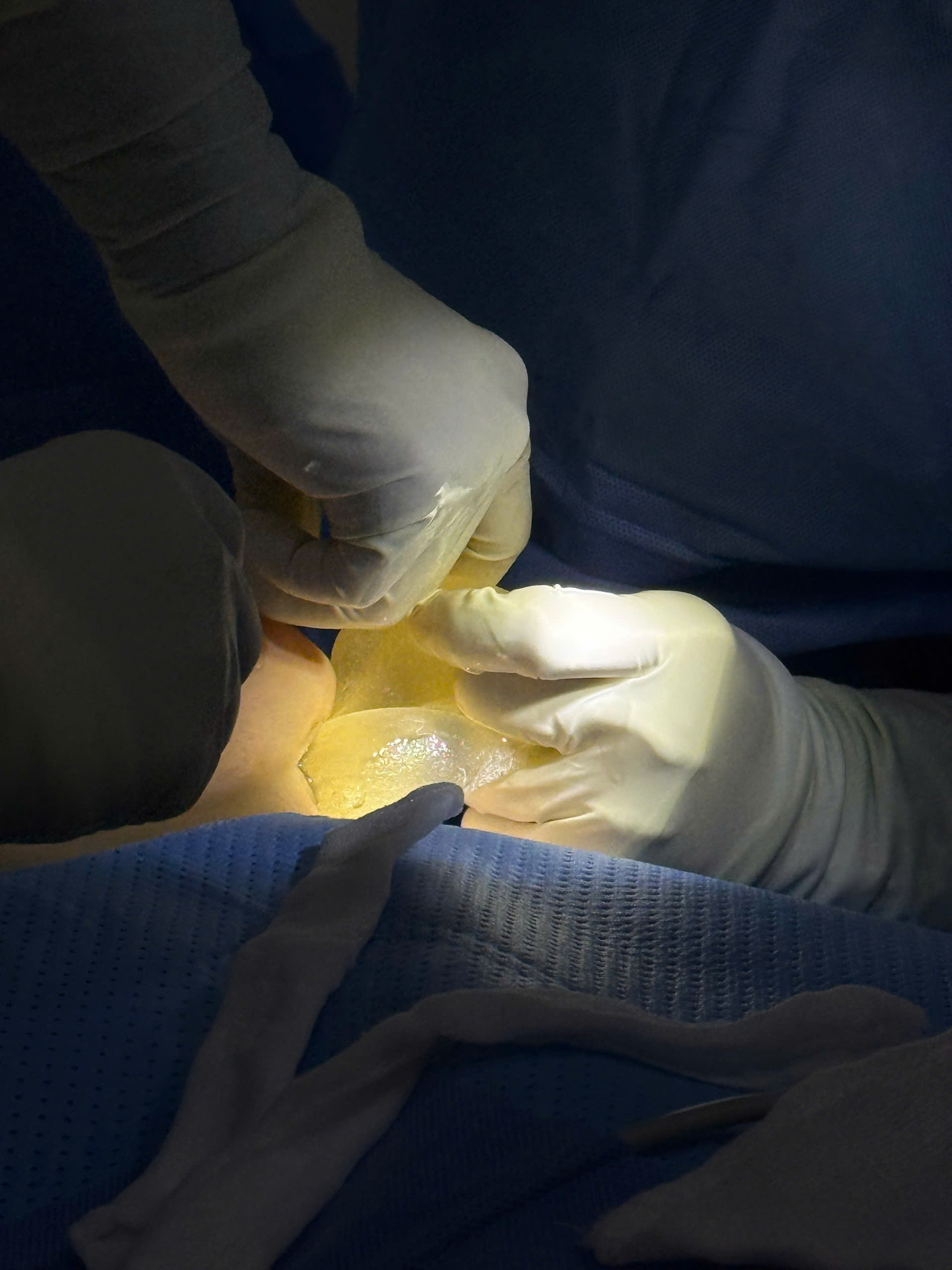 Breast Implant Removal in Vietnam: Cost & Safety Guide
