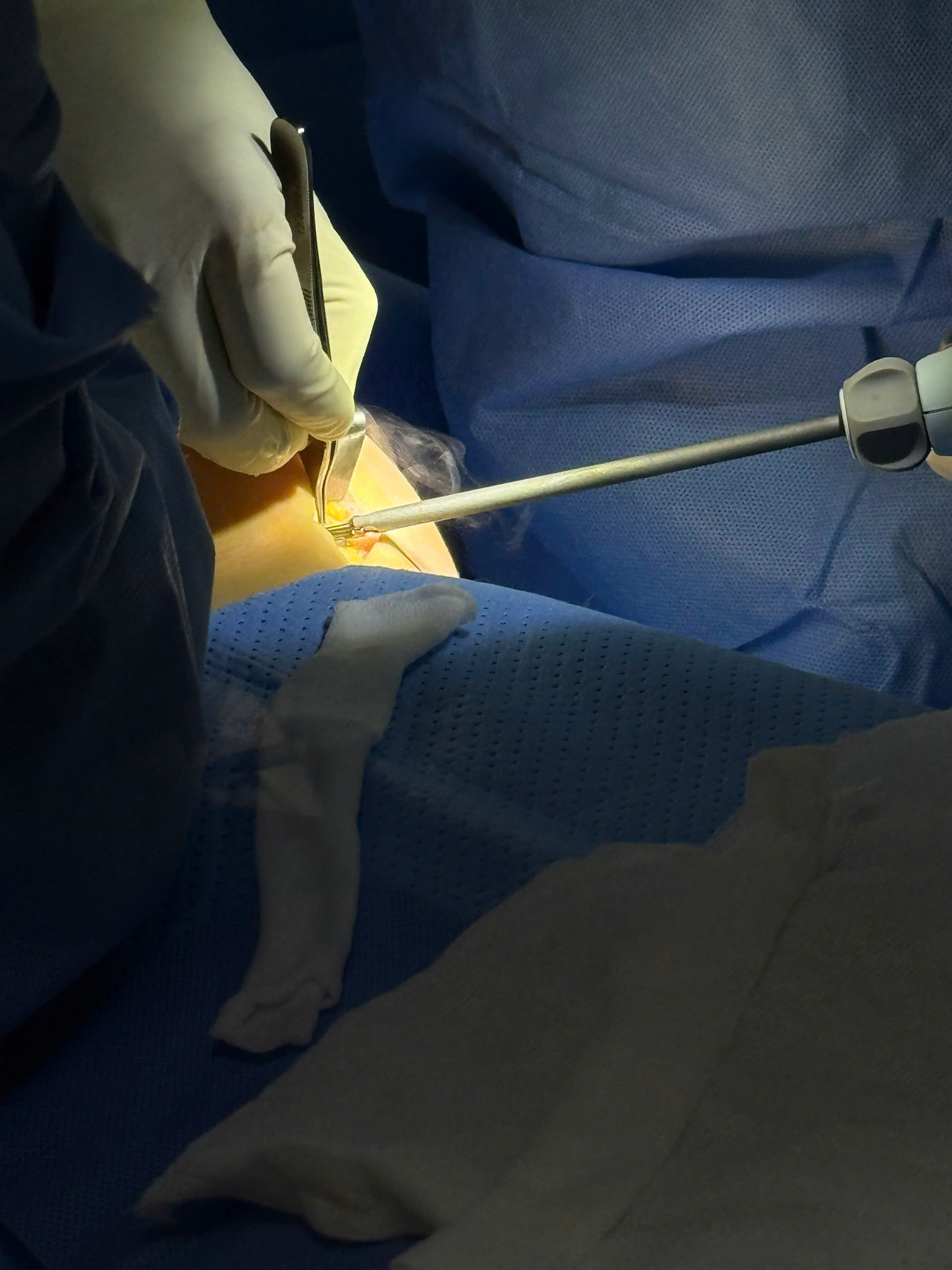 Breast Implant Removal in Vietnam: Cost & Safety Guide