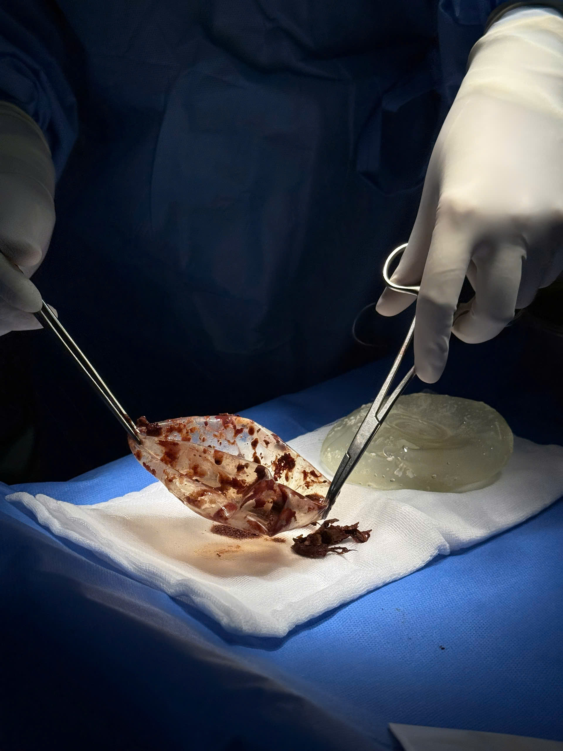 Breast Implant Removal in Vietnam: Cost & Safety Guide