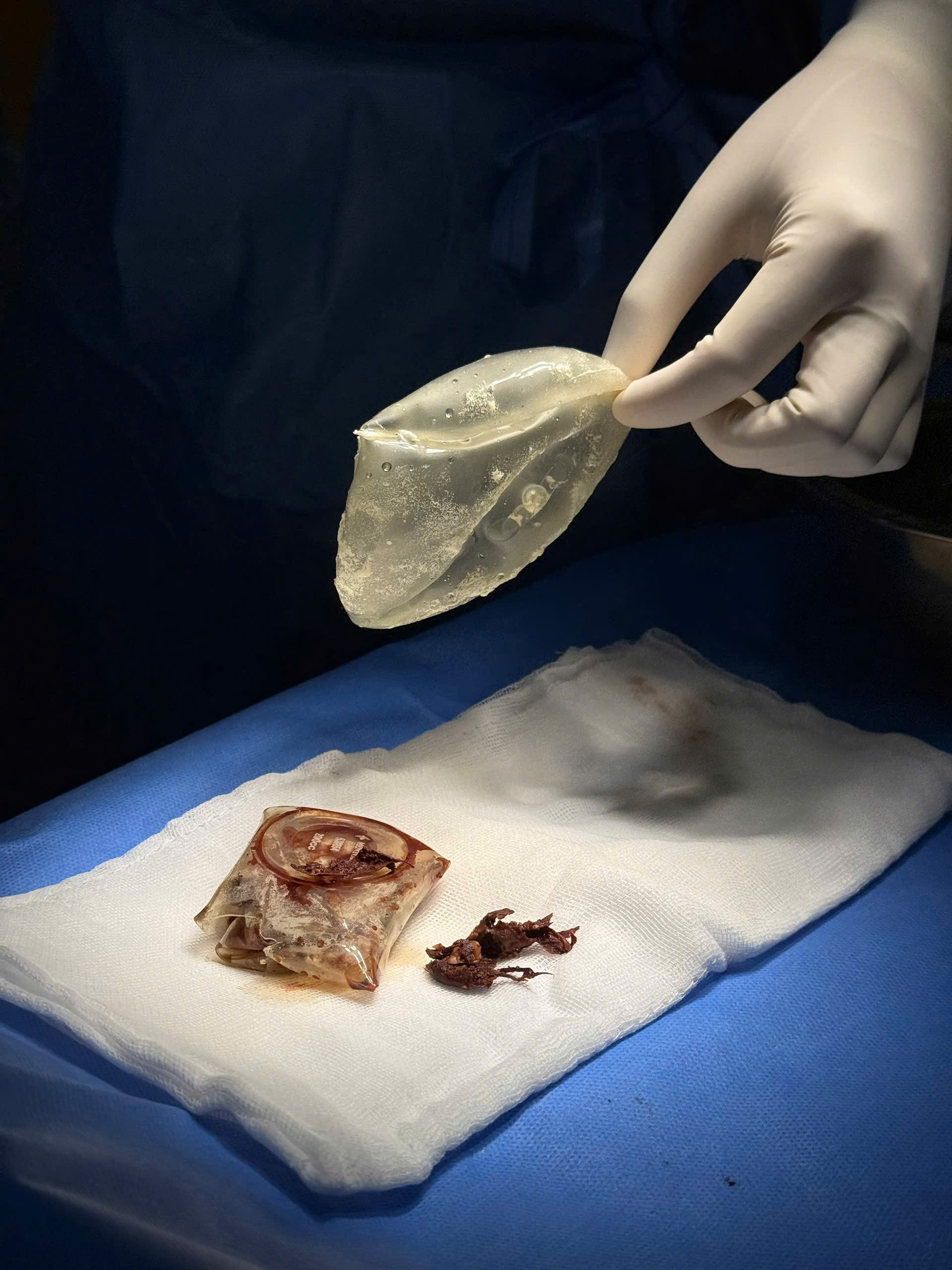 Breast Implant Removal in Vietnam: Cost & Safety Guide