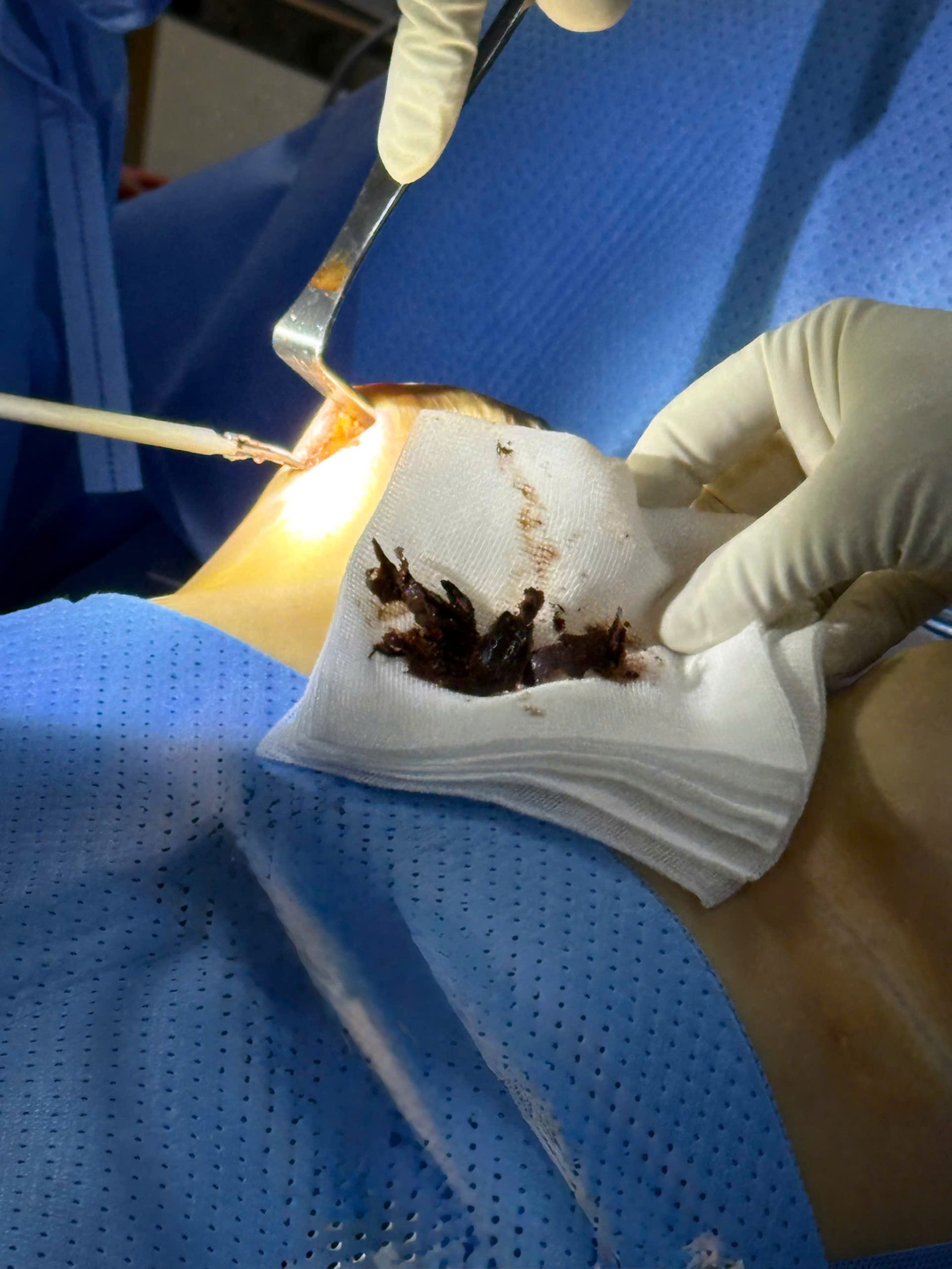 Breast Implant Removal in Vietnam: Cost & Safety Guide