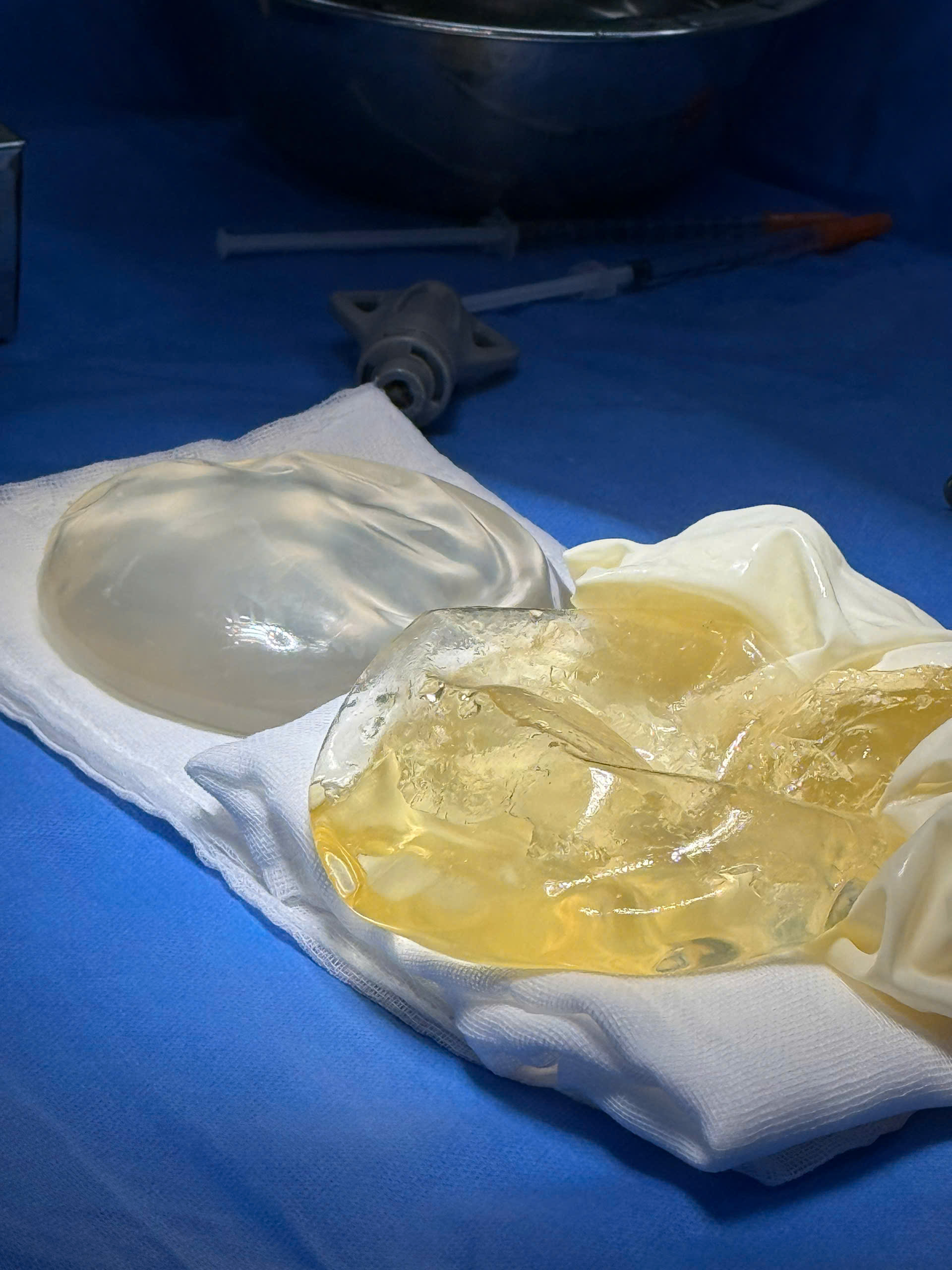 Breast Implant Removal in Vietnam: Cost & Safety Guide