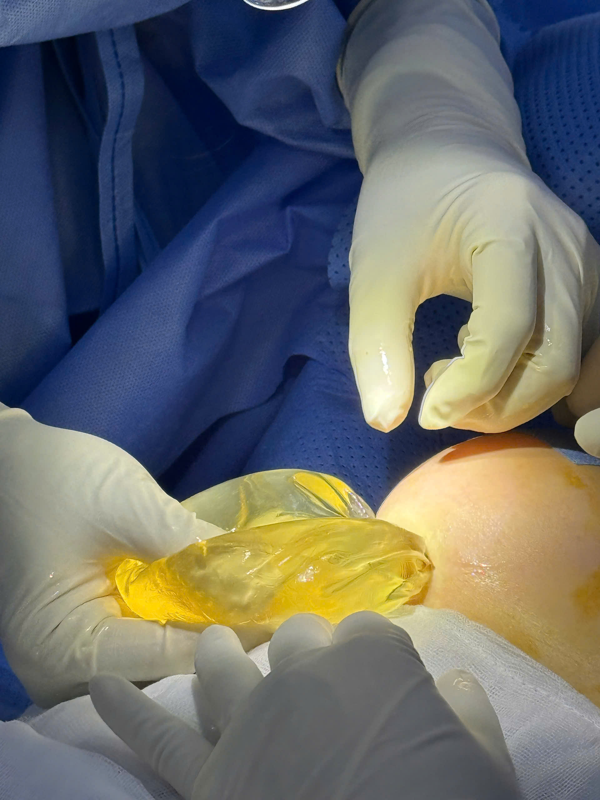 Breast Implant Removal in Vietnam: Cost & Safety Guide