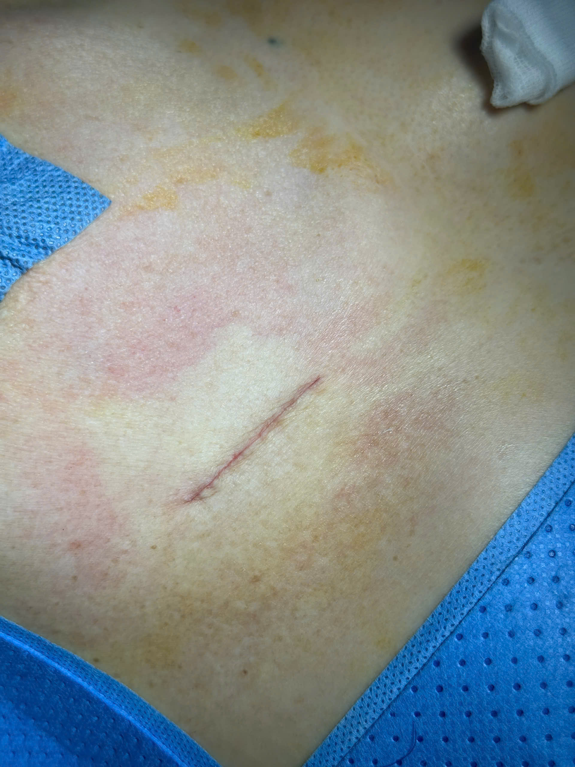 Breast Implant Removal in Vietnam: Cost & Safety Guide